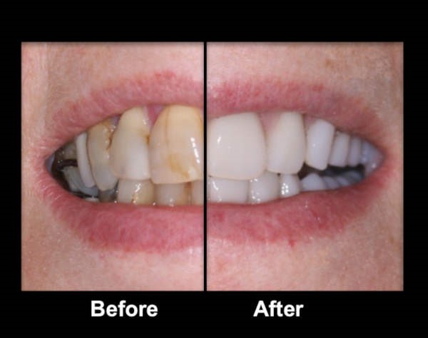 Cleaning 
      Partial Dentures Buda TX 78610